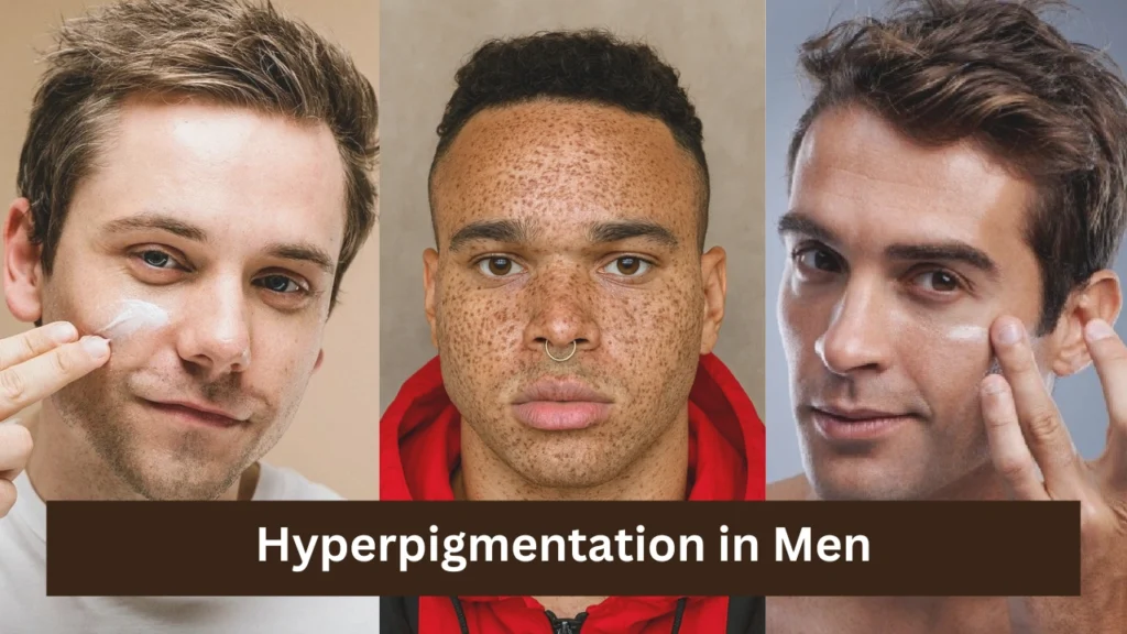 Hyperpigmentation in Men
