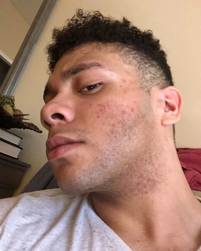 Shaving Related Pigmentation