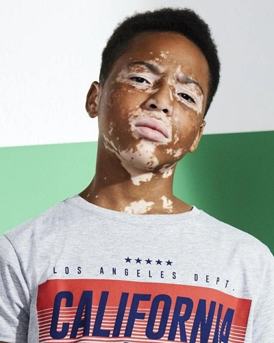 Men with Vitiligo Around Mouth