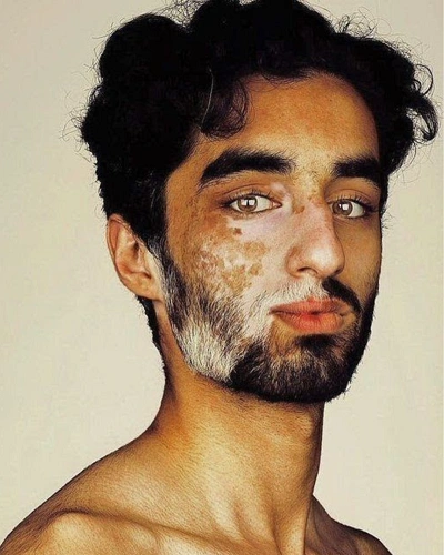 Men with Vitiligo Around Mouth