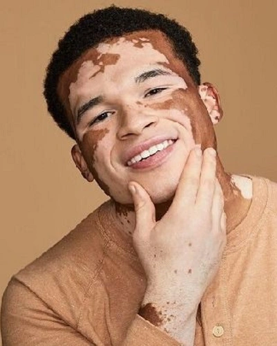 Men with Vitiligo on the Hands