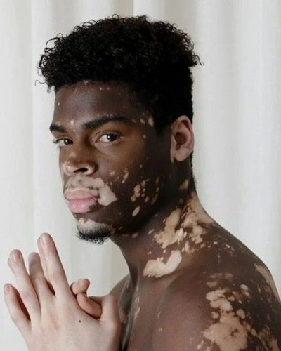 Men with Vitiligo Around the Ears