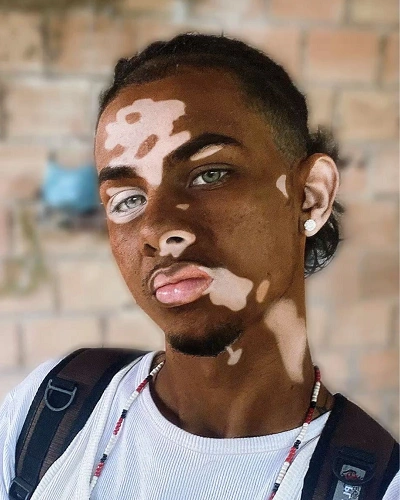 Men with Vitiligo Around the Ears