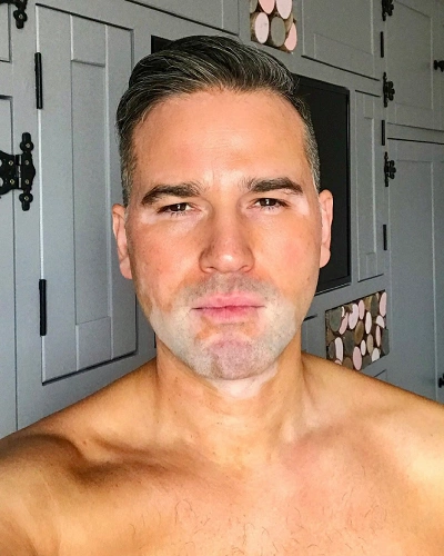 Men with Vitiligo in the Beard Area