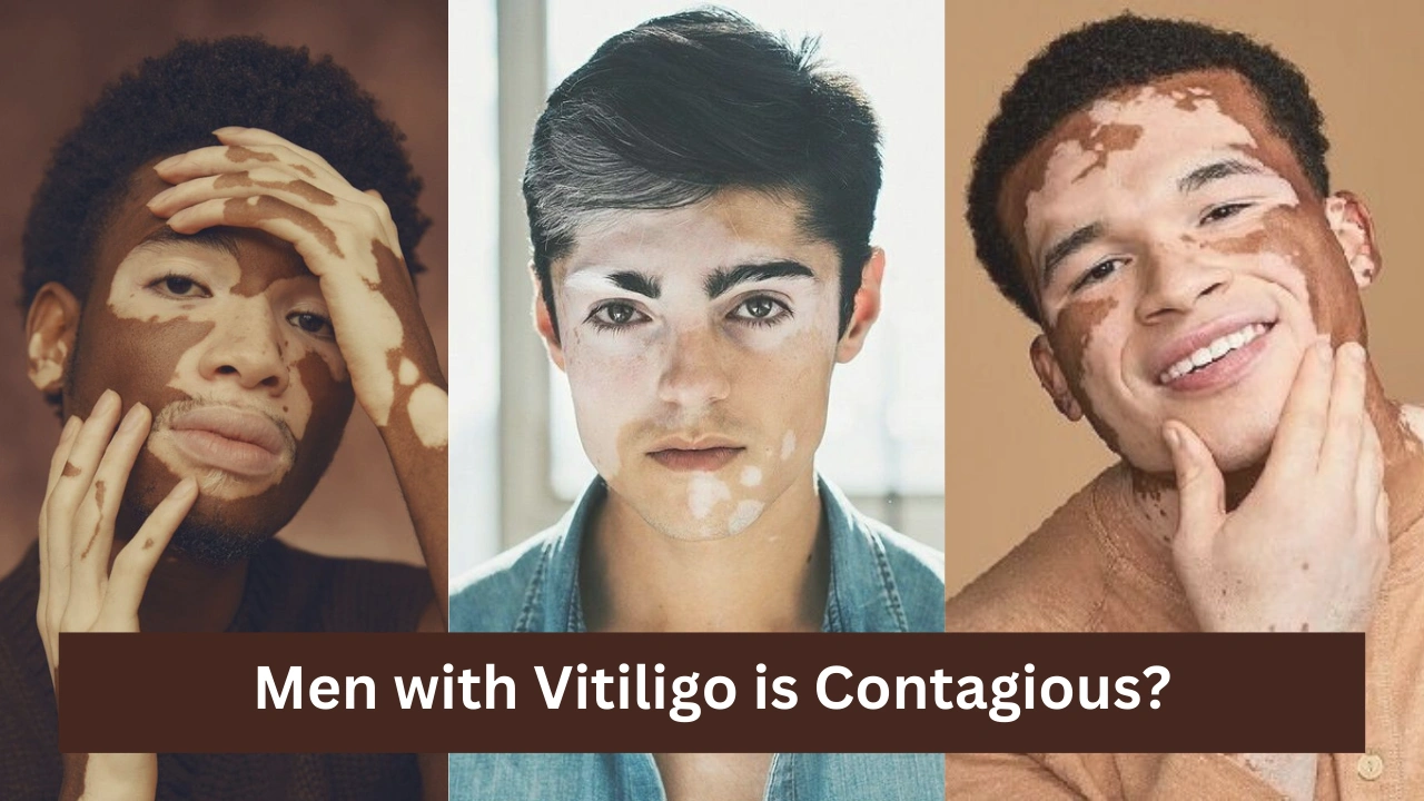 Men with Vitiligo is Contagious?