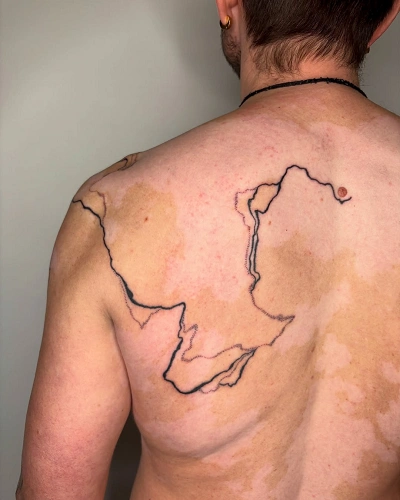 Men with Vitiligo on the Back