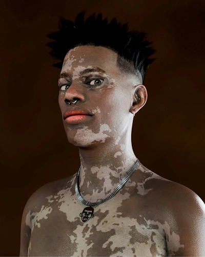 Men with Vitiligo on the Chest