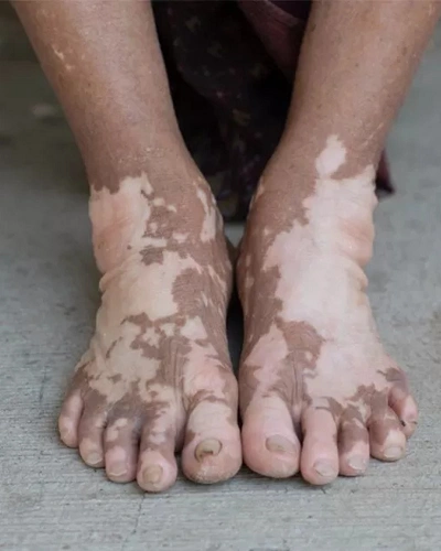 Men with Vitiligo on the Feet