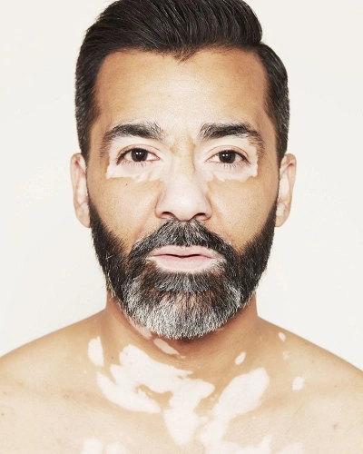 Men with Vitiligo on the Neck
