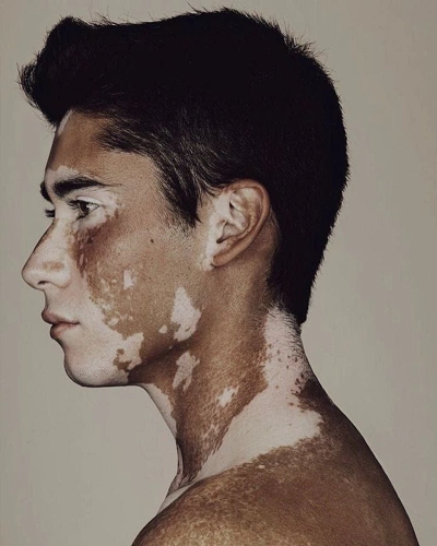 Men with Vitiligo on the Neck