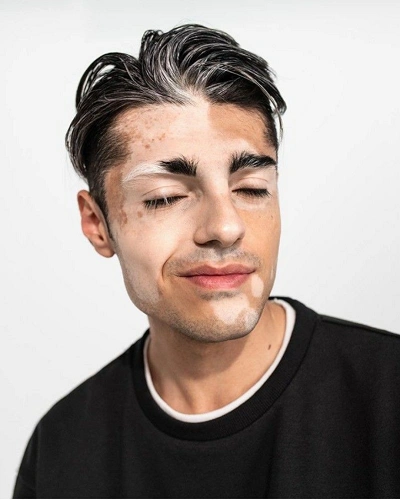 Men with Vitiligo on the Scalp