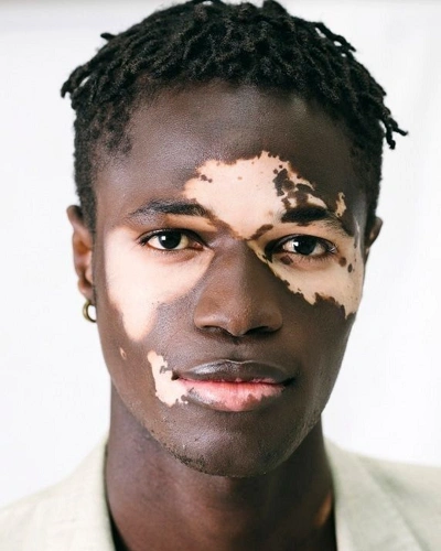 Vitiligo in Black Men